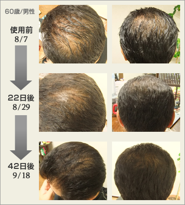 養毛 育毛に 新スカルプケア